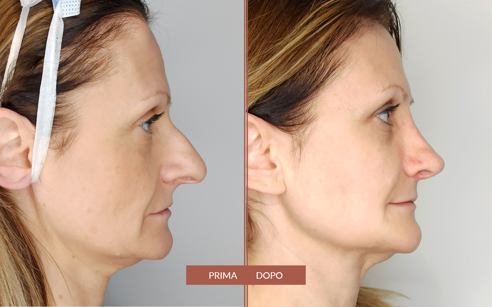 Preservation Rhinoplasty / Lipofilling Full-Face