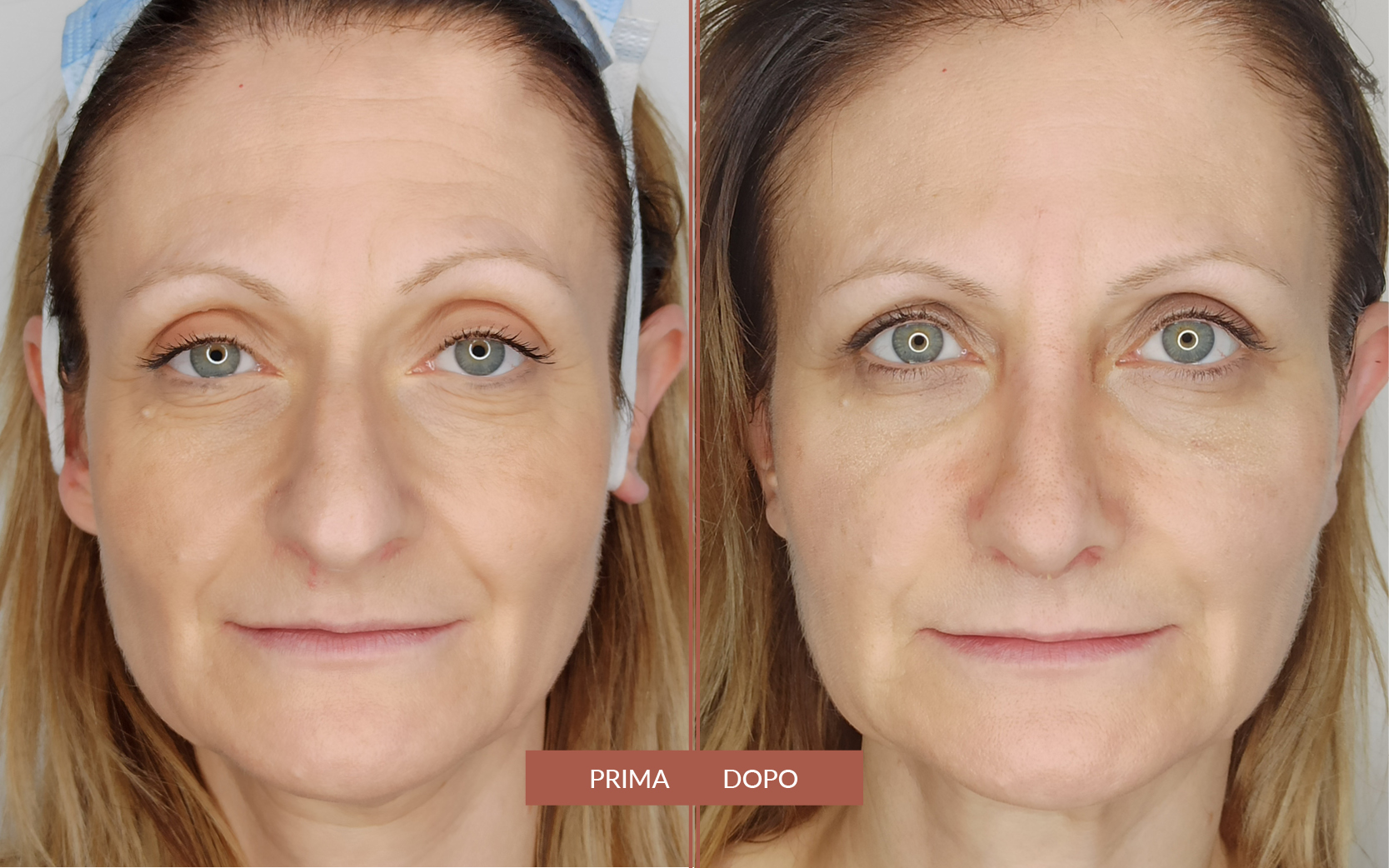 Preservation Rhinoplasty / Lipofilling Full-Face