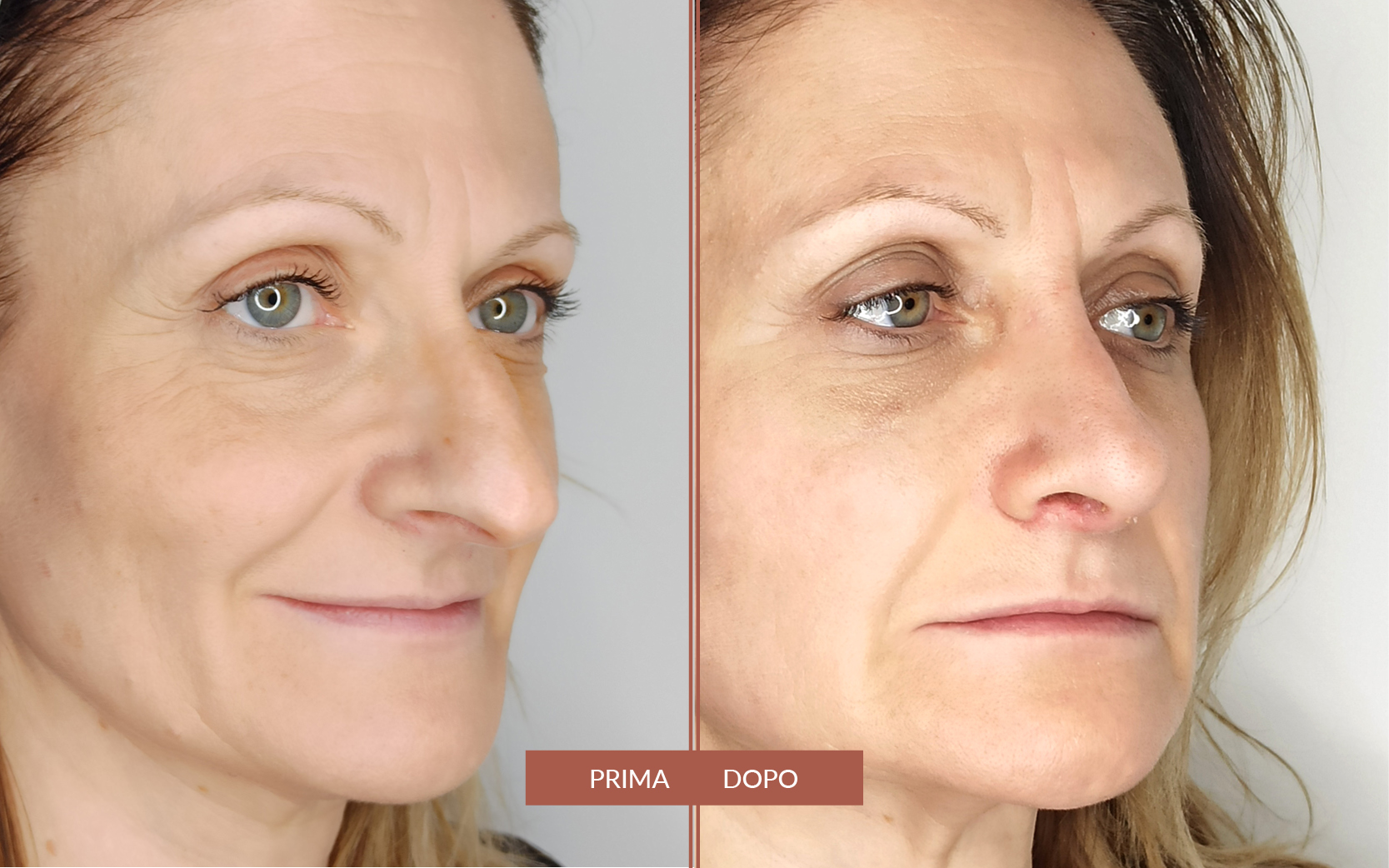 Preservation Rhinoplasty / Lipofilling Full-Face